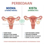 Mengenal Penyakit Miom dan Kista: Gejala, Penyebab, dan Cara Mengobati