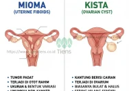Mengenal Penyakit Miom dan Kista: Gejala, Penyebab, dan Cara Mengobati